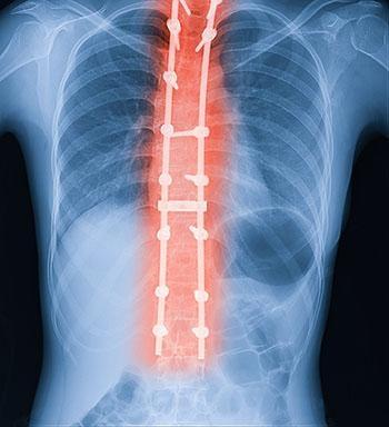 45mil spine surgery death