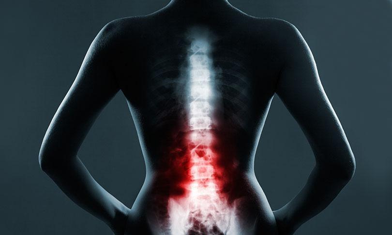 woman won 56mil spine surgery